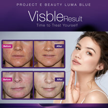 Load image into Gallery viewer, Luma Blue | Acne Light Therapy Cleansing Brush 415nm Blue Photon LED 360° Rotation Reduce Inflammation Smooth Improving Sensitive Skin Calming Anti Bacteria Treatment Facial Device
